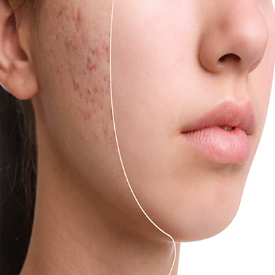 Congestive Acne